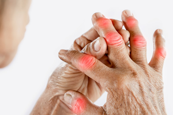 types of arthritis